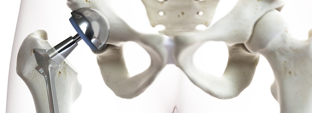 Hip replacements are one of the many common medical procedures that would be impossible to perform without modern machining technology. | Image courtesy of Seco